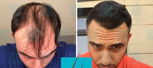 Trapianto capelli di Michele R. prima e dopo