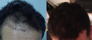 Trapianto capelli di Paolo prima e dopo