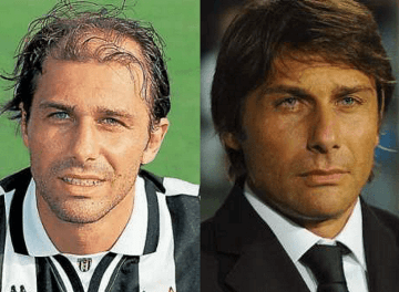 Stella del calcio Antonio Conte prima e dopo il trapianto FUT