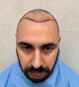 Foto di un uomo pelato con segni sulla fronte