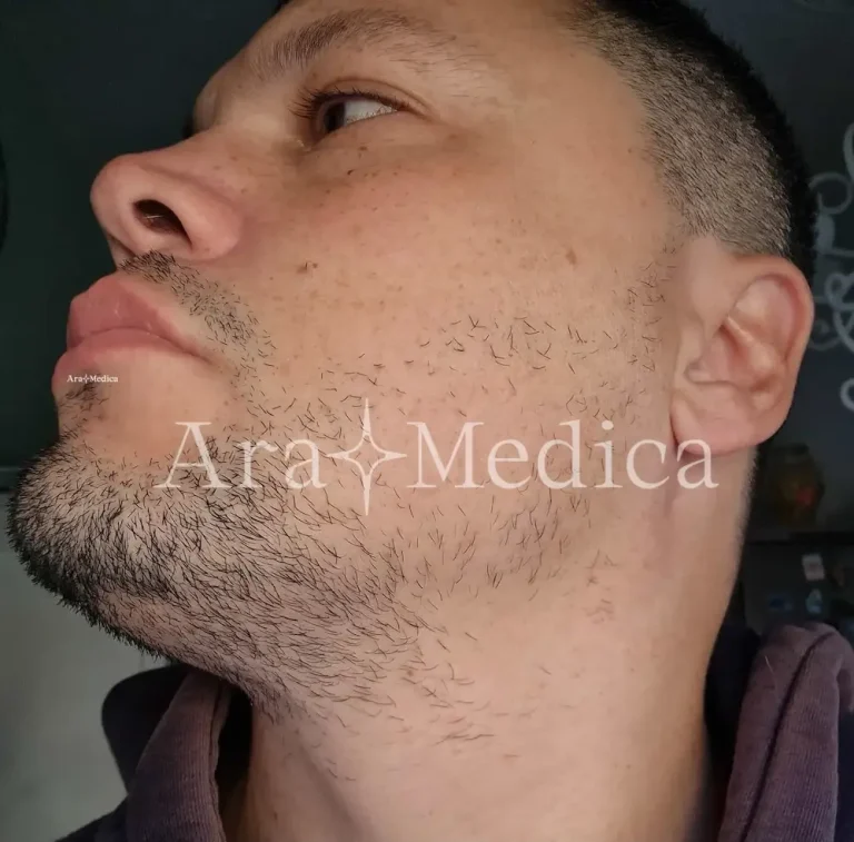 Alopecia barba