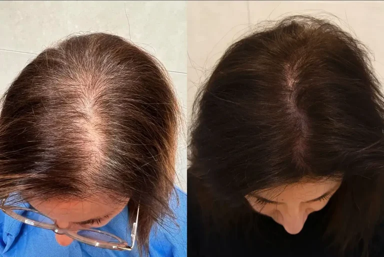 Alopecia femminile