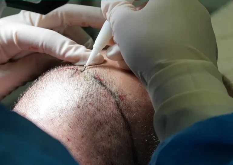 Tecnica DHI