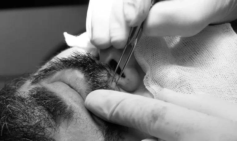 Trapianto della barba