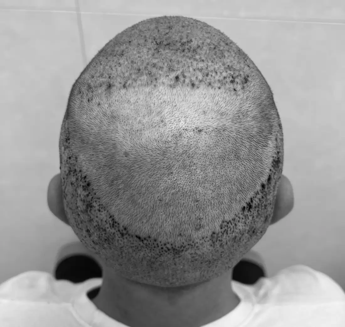 gonfiore e lividi post trapianto capelli