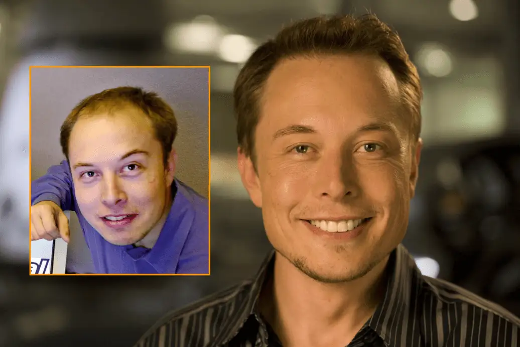 Elon Musk prima e dopo trapianto capelli
