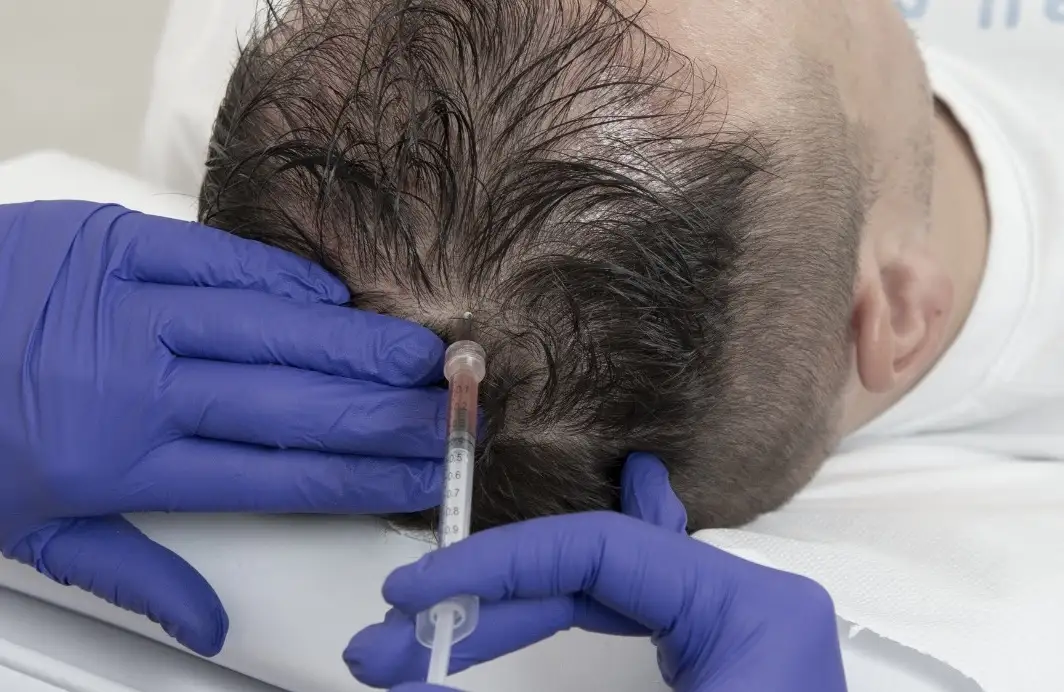 Prp capelli