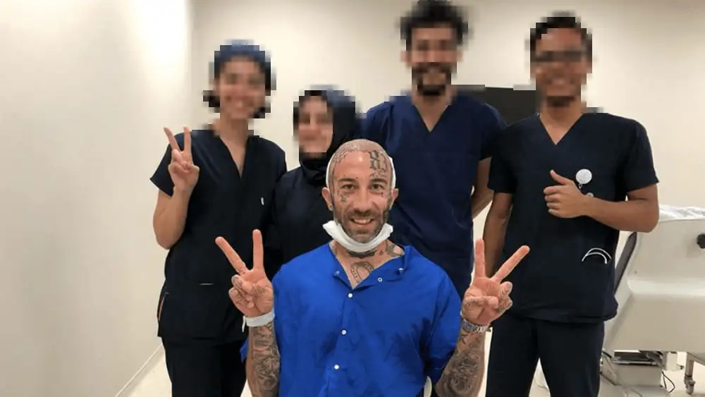 Simone Coccia trapianto capelli